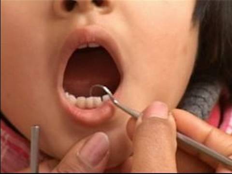 Bebek Diş Çıkarma Belirtileri Ve Yardım: Ne Zaman Çocuk Süt Dişleri Kaybedersin?