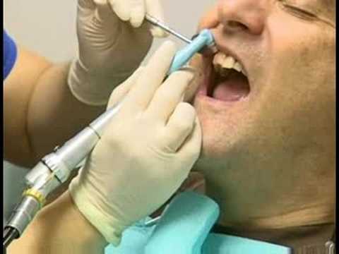 Diş Bakımı: Koronal Diş Parlatma : Koronal Diş Parlatma: Diş İçin Macun Uygulayarak 