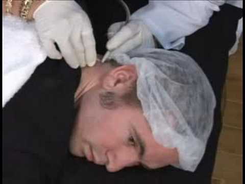 Elektroliz Epilasyon: Elektroliz Erkek Boyun Saç Kaldırma Tedavi