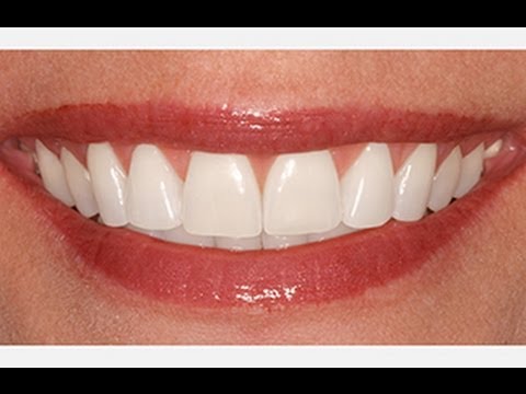 Photoshop: Nasıl Aydınlatmak Ve Dişleri Beyazlatmak İçin!