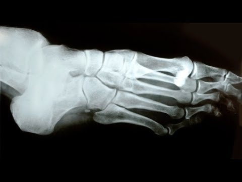 Çekiç Ayak Parmağı Olup Olmadığını Nasıl | Ayak Bakımı