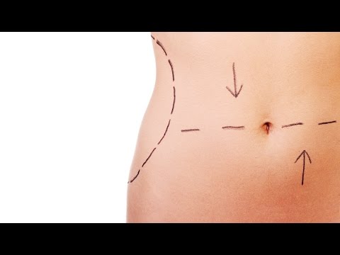 Tummy Tuck Vs Liposuction | Plastik Cerrahi